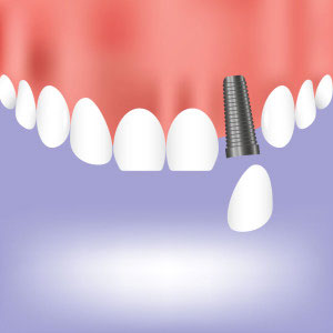 Above Dental offers dental implant services in Coos Bay and North Bend
