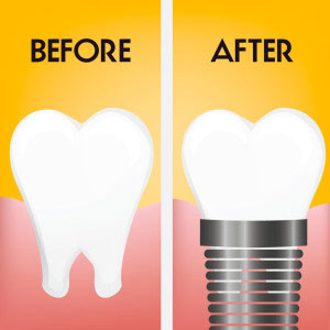 We offer dental implants to our patients in North Bend and Coos Bay
