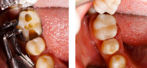 Above Dental composite resin white fillings