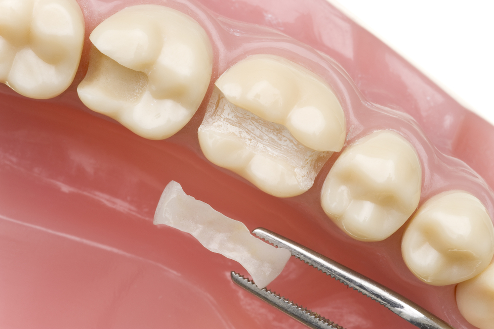 Image result for white dental fillings