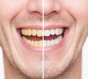 How does teeth whitening work?