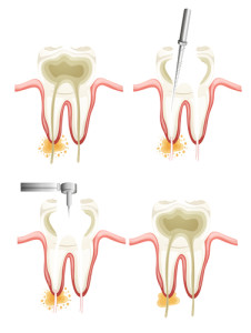 Illustration showing a root canal procedure