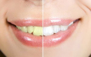 Professional teeth whitening treatment at our Coos Bay/North Bend dental clinic
