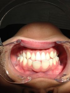 gum disease treatment north bend or