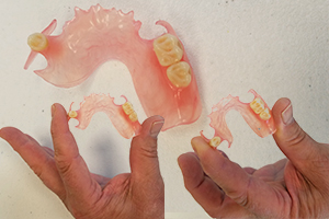 Flexible dentures are a viable alternative to partial dentures